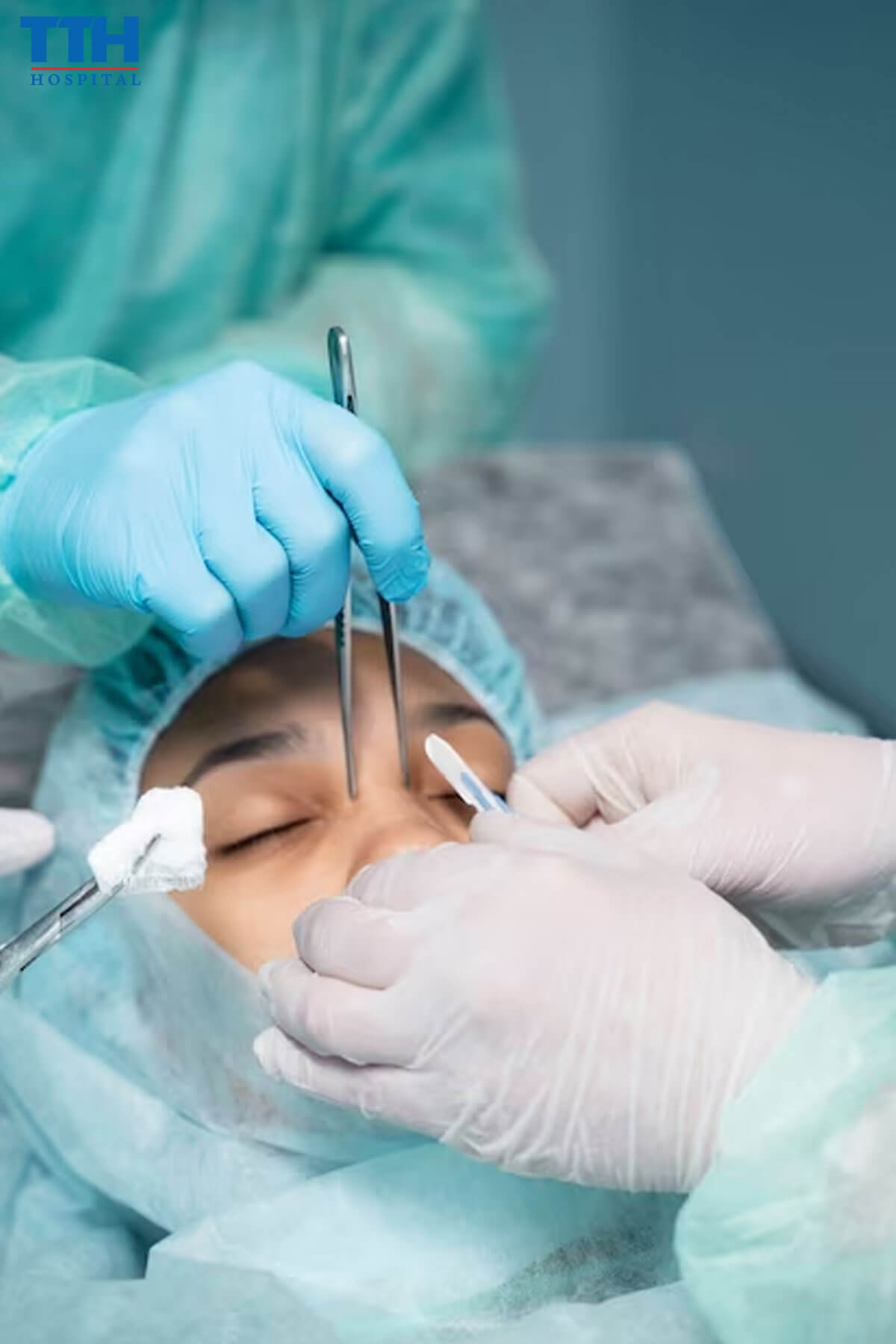 Nâng Mũi Bằng Sụn Là Gì - Nâng mũi tại Vinh Nghệ An