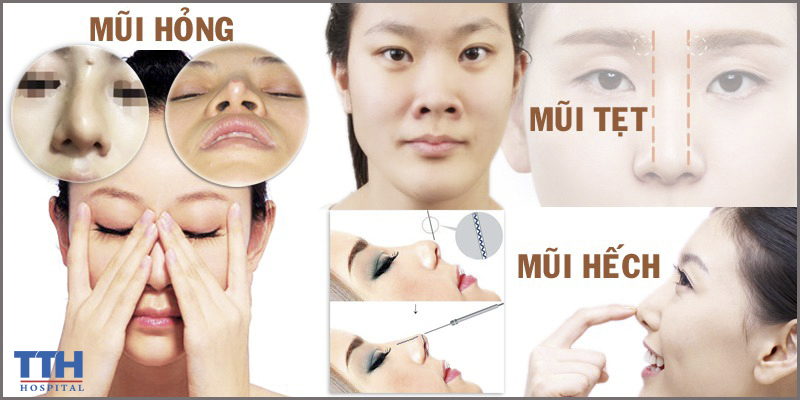 Nâng mũi cấu trúc khắc phục những tình trạng nào?