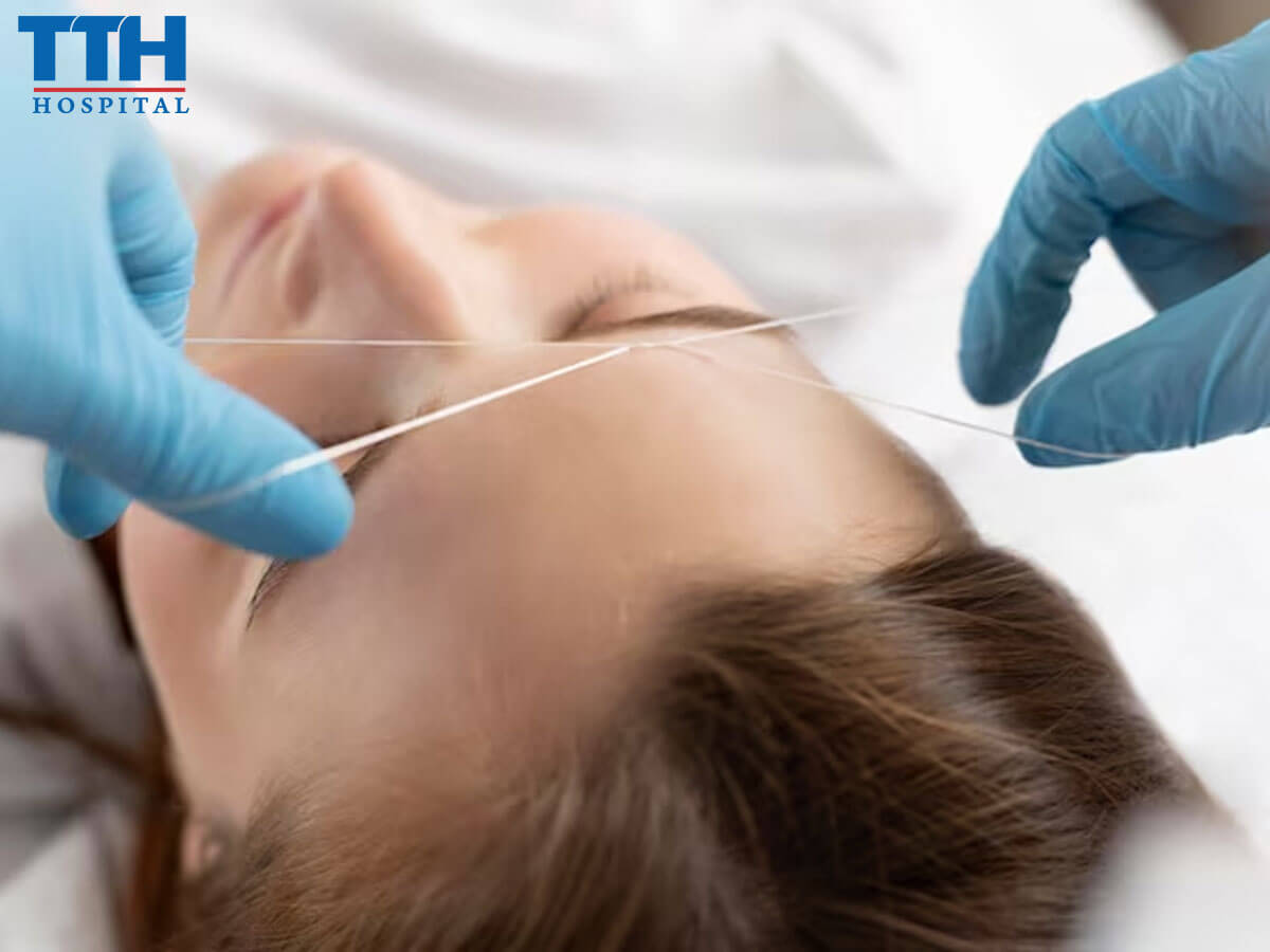 Nâng Mũi Chỉ Hiko Là Gì? - nâng mũi tại Vinh