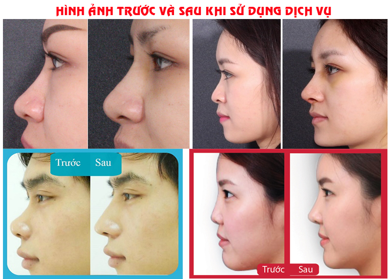 Bệnh viện Thái Thượng Hoàng - Địa chỉ nâng mũi tại Vinh, Nghệ An tốt nhất