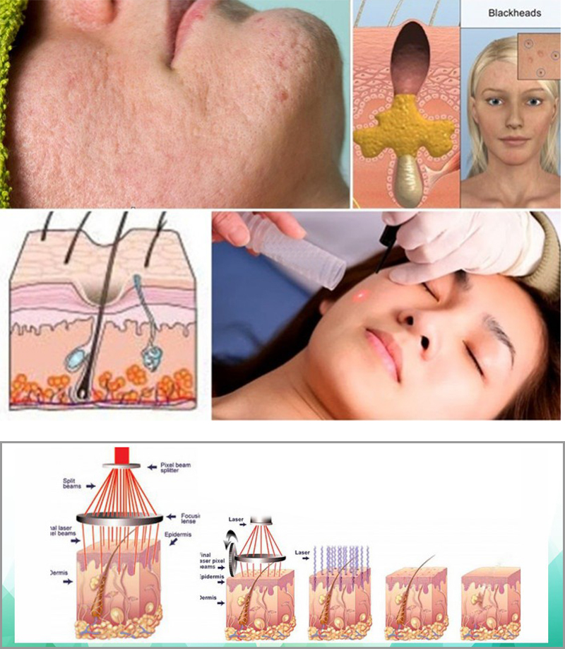 Phương pháp trị sẹo với công nghệ CO2 FRACTIONAL LASER