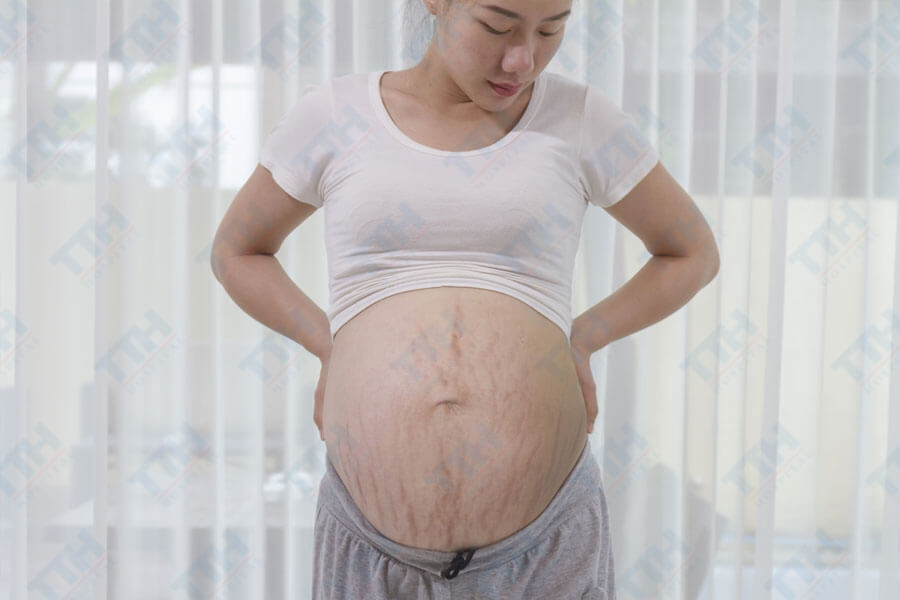 Rạn da (Stretch marks)