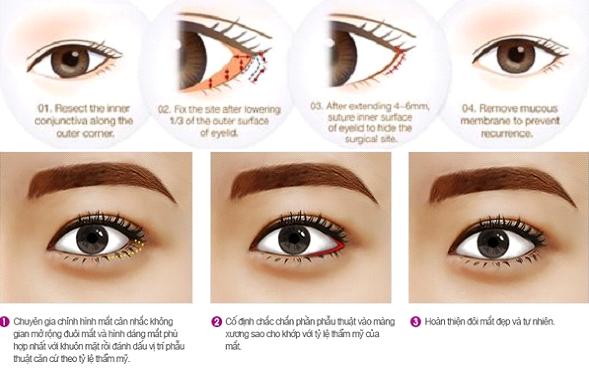 Phẫu thuật mắt to tại Bệnh viện Thái Thượng Hoàng được xem là giải pháp