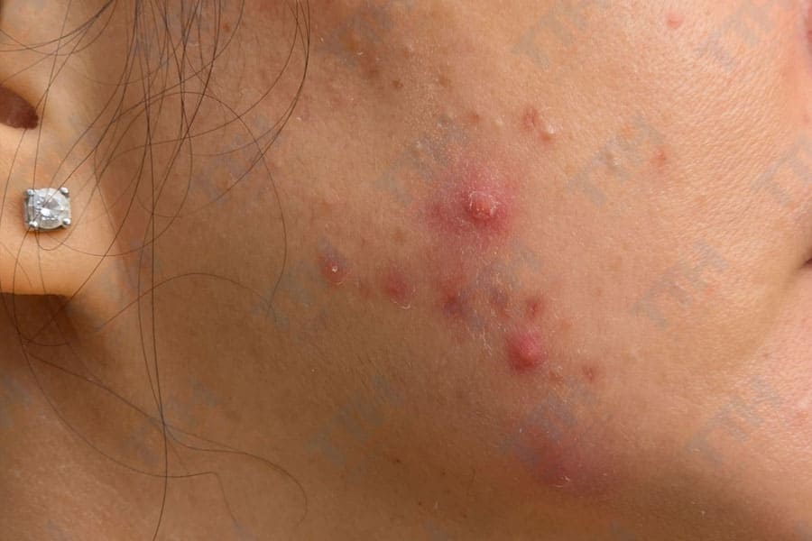 Phân biệt các loại mụn cần điều trị