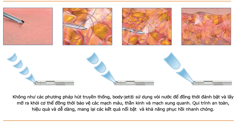 Thế nào là hút mỡ công nghệ Body Jet?