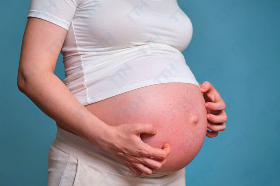 PUPPP (Pruritic Urticarial Papules and Plaques of Pregnancy)