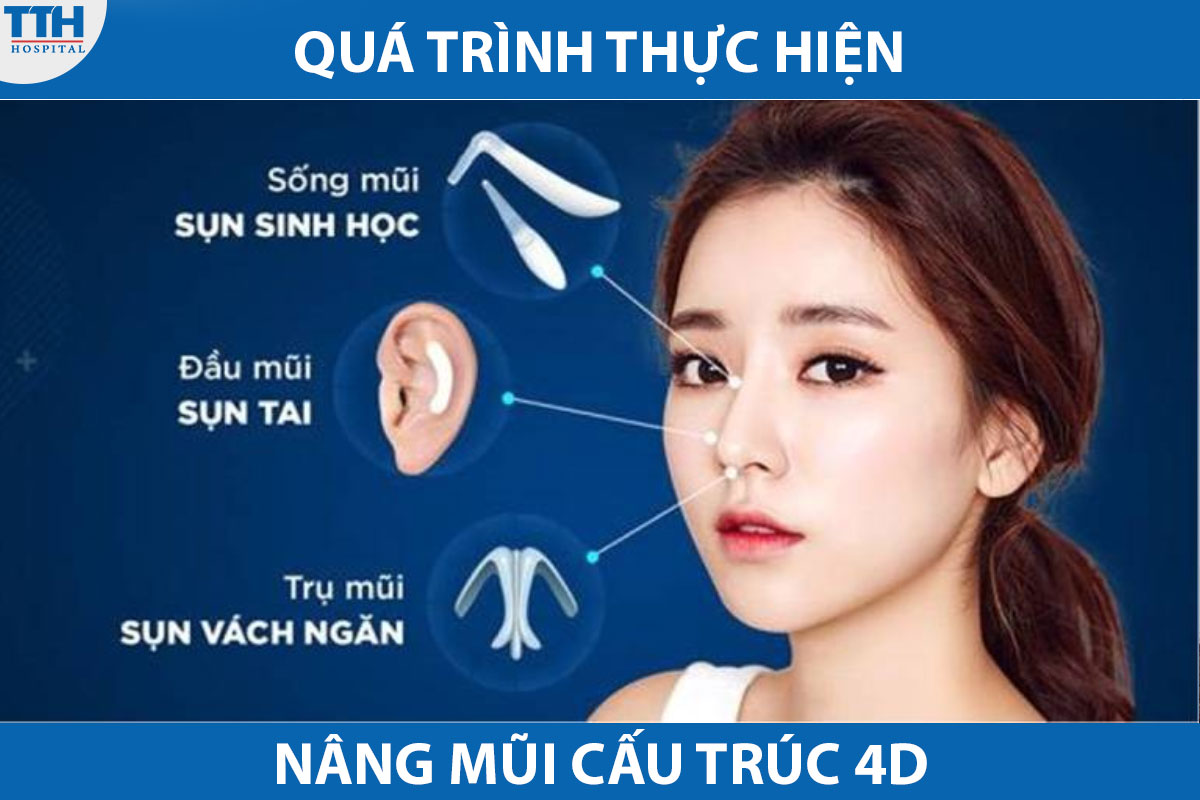 Quá trình nâng mũi cấu trúc 4D