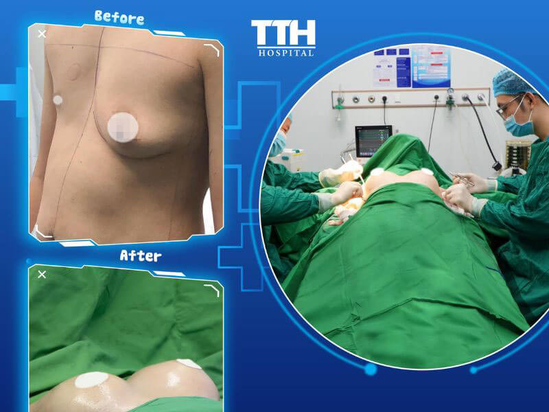 Quy trình nâng ngực tại Bệnh viện Thái Thượng Hoàng
