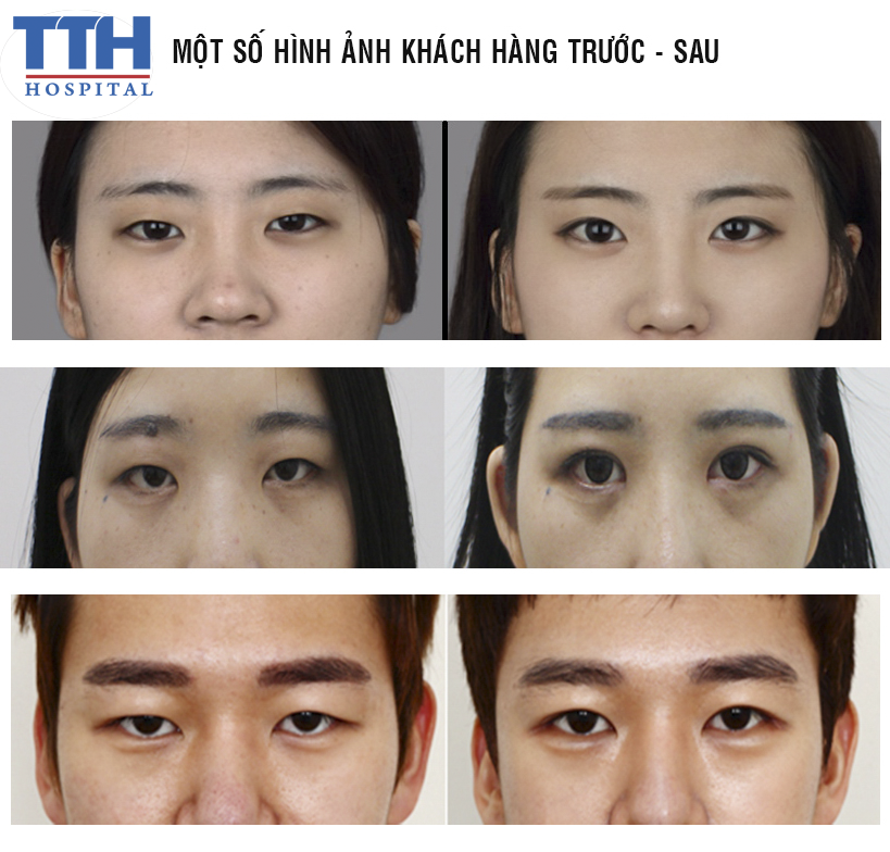 Hình ảnh khách hàng trước và sau nâng mũi cấu trúc