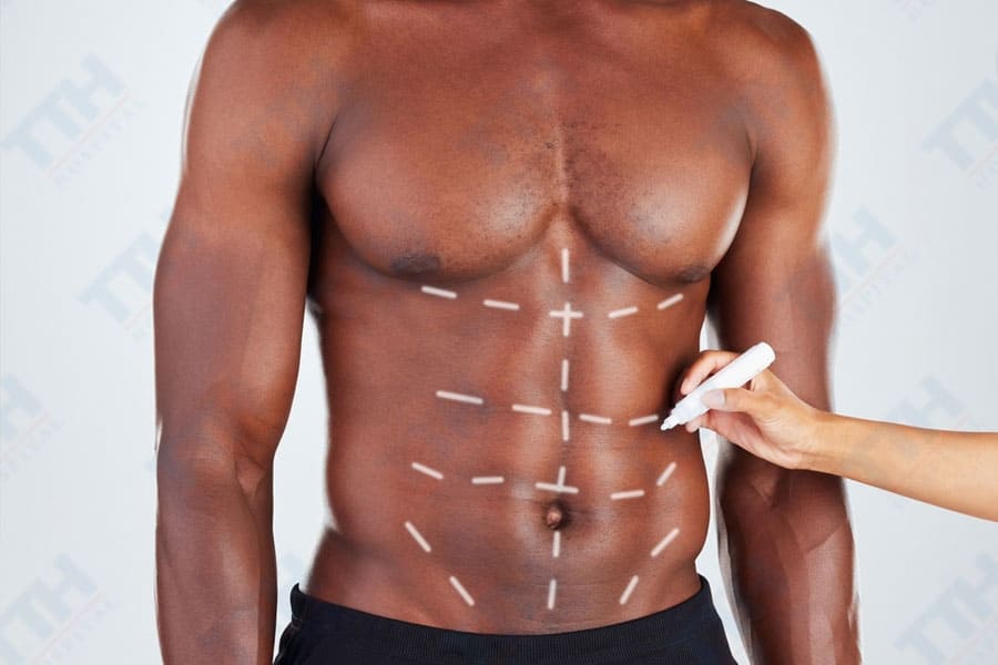 Tạo hình bụng sáu múi - Giải pháp thẩm mỹ cho cơ thể hoàn hảo