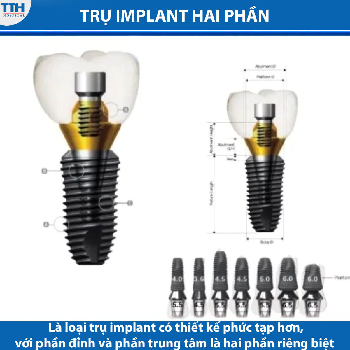 Trụ implant hai phần