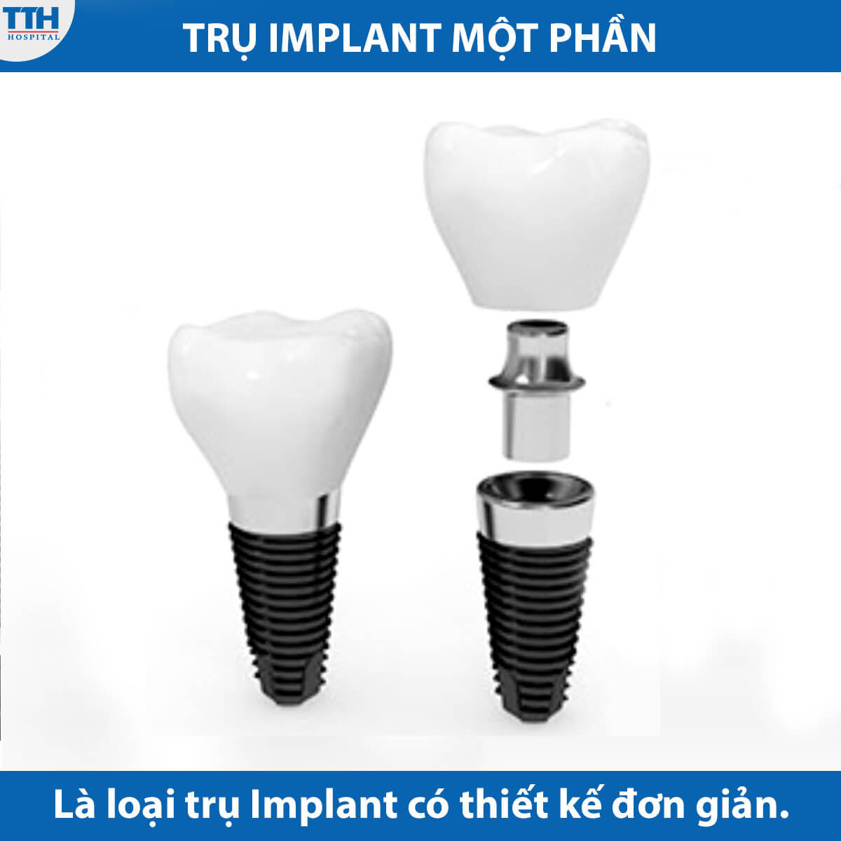 Trụ implant một phần