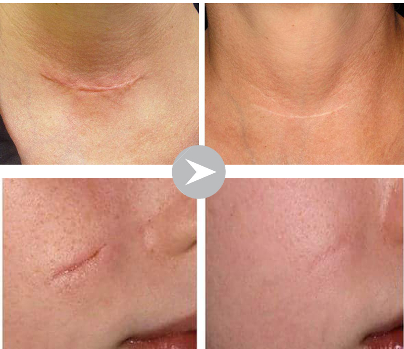 Giải đáp thắc về phương pháp trị sẹo công nghệ CO2 FRACTIONAL LASER