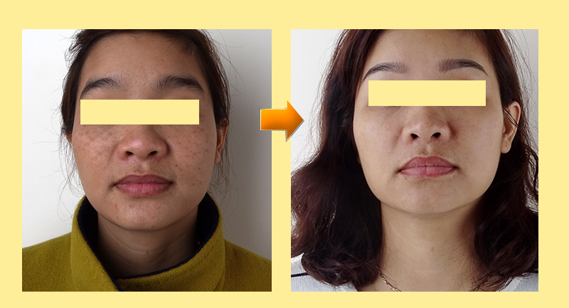 Trước khi thực hiện trị nám, khách hàng sẽ được bác sĩ thăm khám một cách cẩn thận