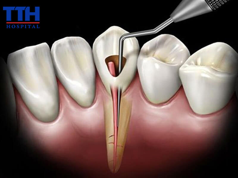 Tủy răng là gì và vì sao cần được điều trị sớm?