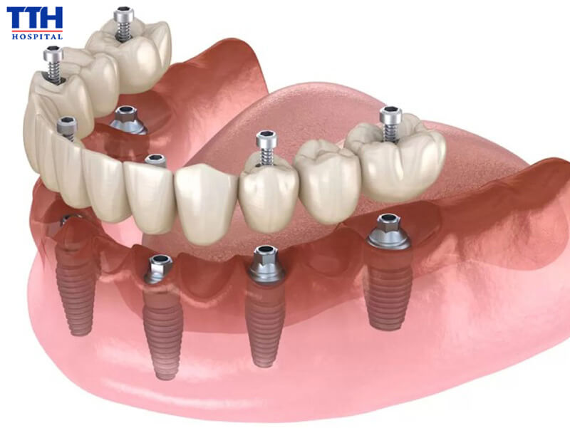 Ứng dụng của Implant Alef trong cấy ghép nha khoa
