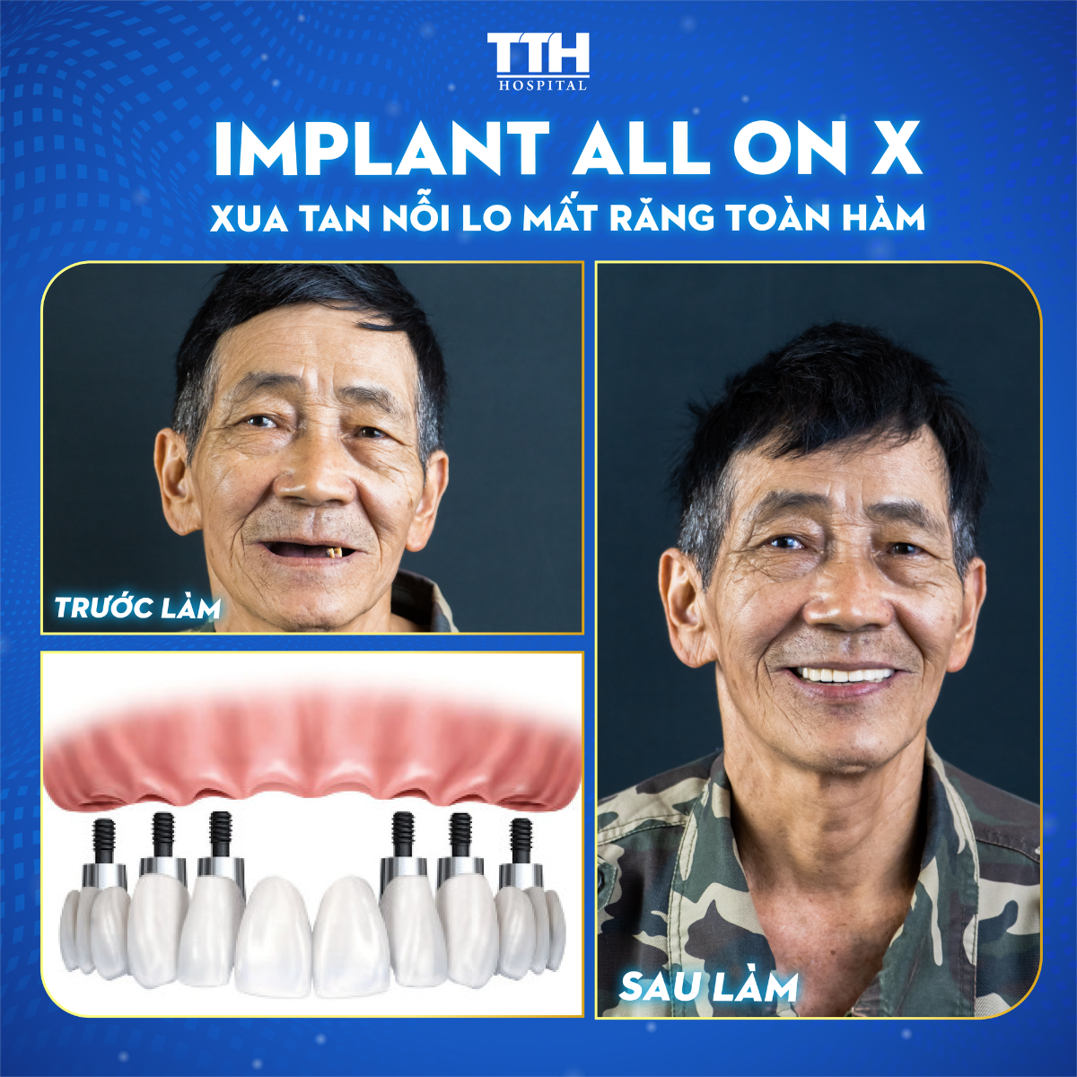 Ưu Điểm của Implant Straumann