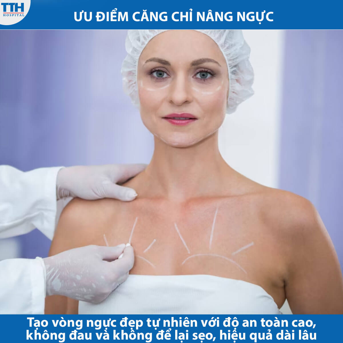 Ưu điểm căng chỉ nâng ngực