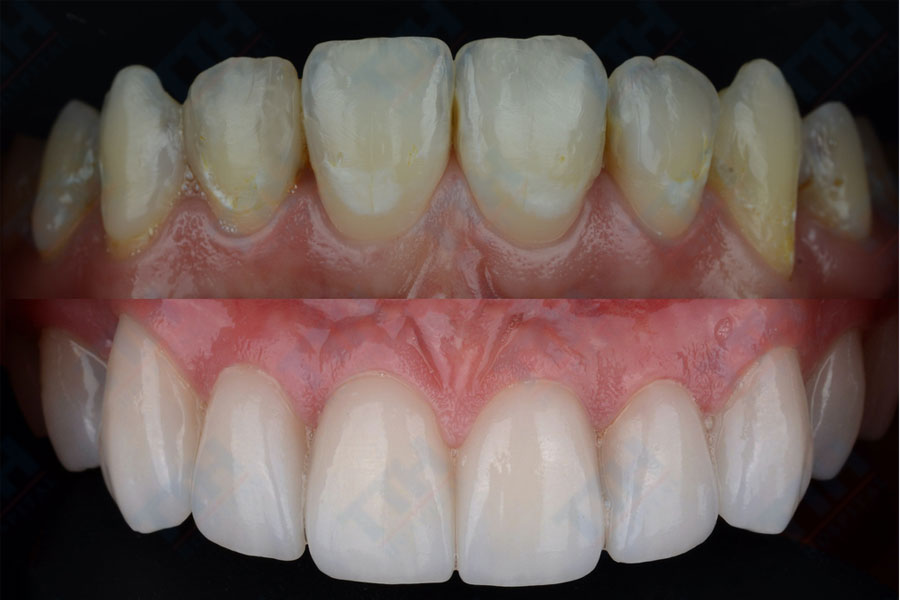Ưu điểm của Orodent White Matt Zirconia