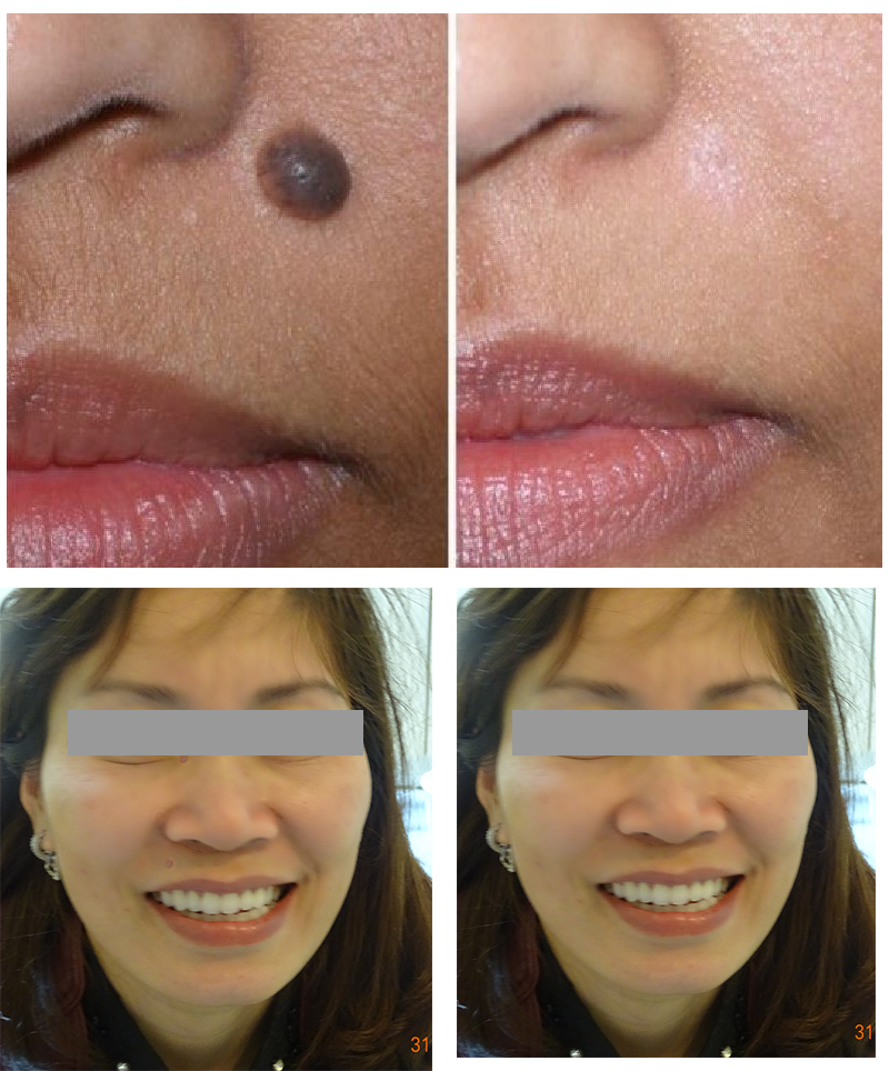 Xóa nốt ruồi