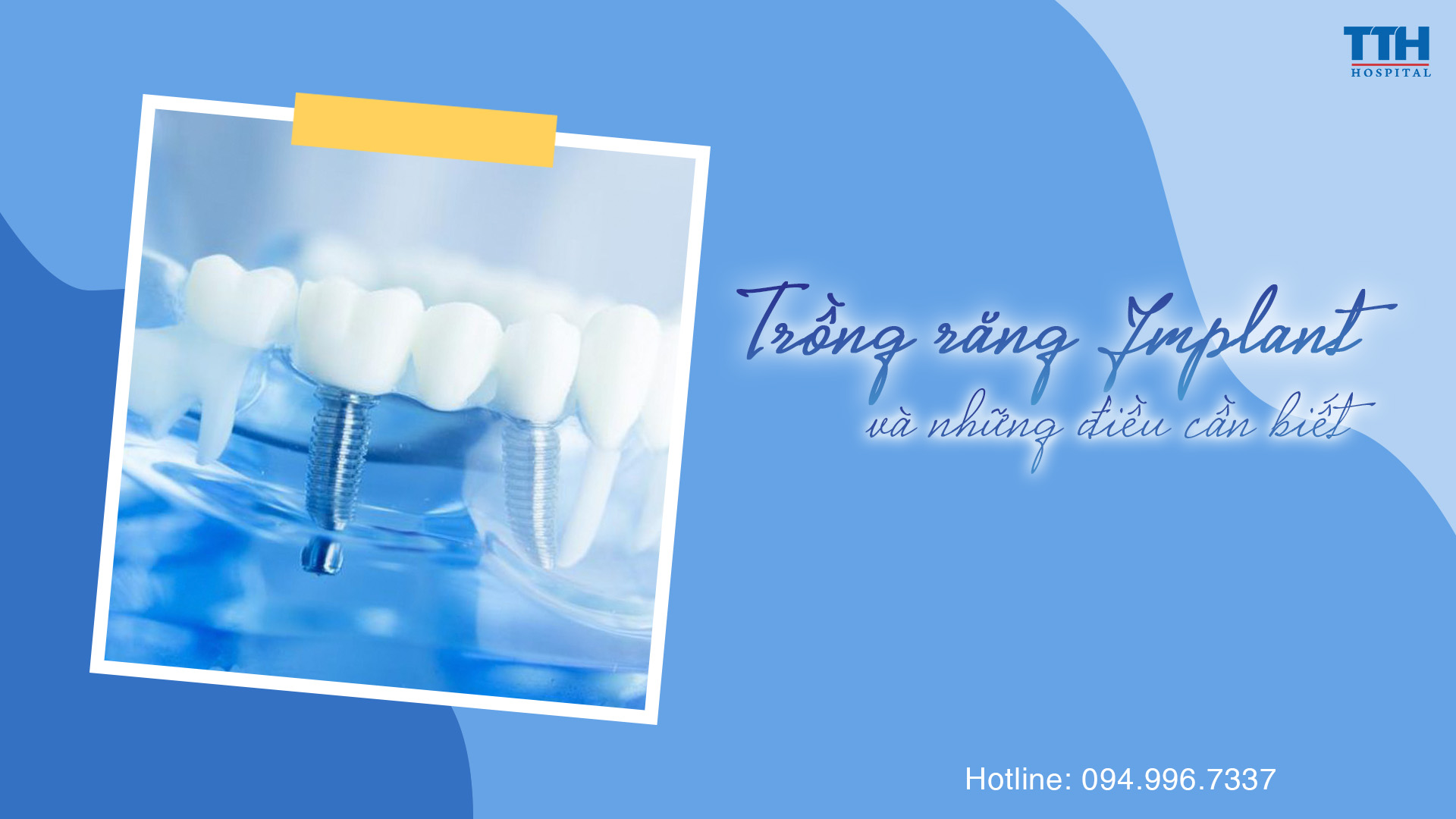 TRỒNG RĂNG IMPLANT VÀ NHỮNG ĐIỀU CẦN BIẾT