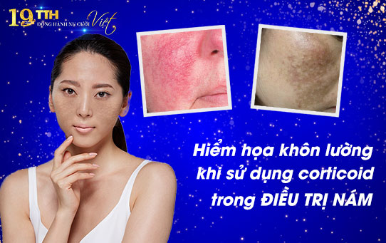 Hiểm họa khôn lường khi sử dụng corticoid trong điều trị nám