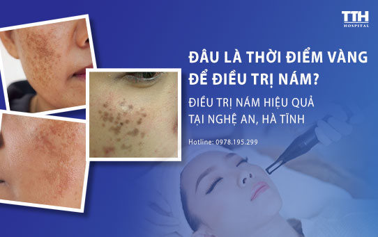 Điều trị nám hiệu quả tại Nghệ An, Hà Tĩnh - Đâu là thời điểm vàng cho trị nám?