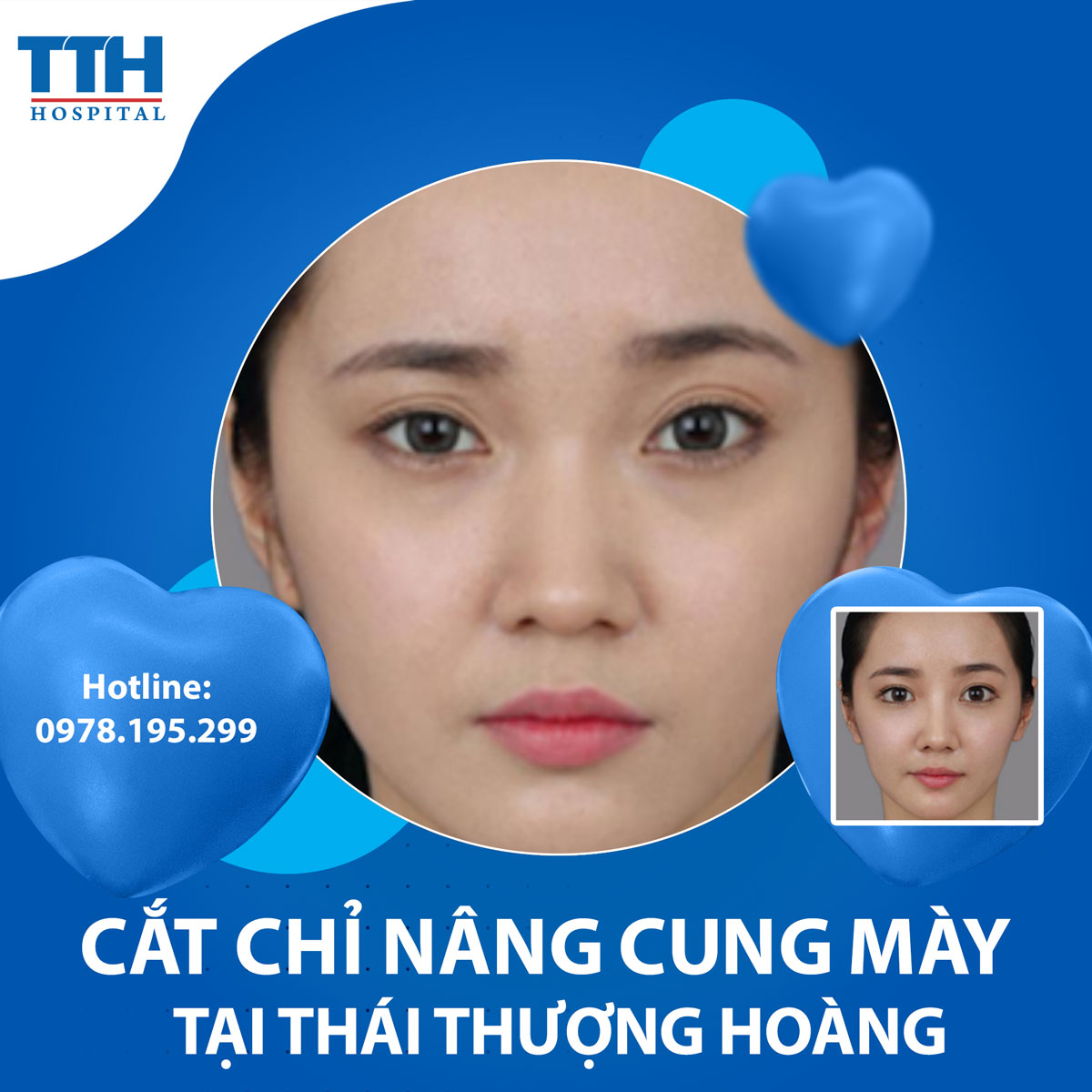 Căng chỉ nâng cung mày