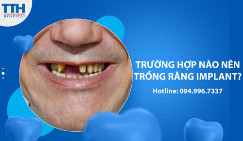 Trường hợp nào nên trồng răng implant?