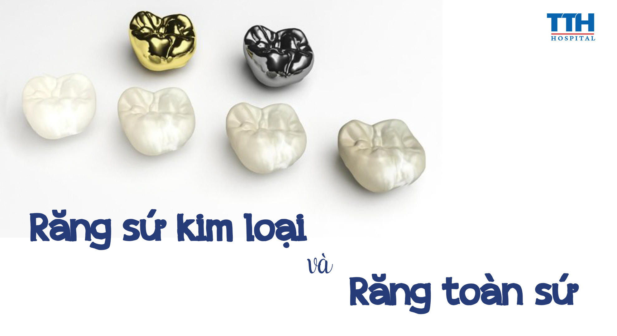 PHÂN BIỆT RĂNG TOÀN SỨ VÀ RĂNG SỨ KIM LOẠI