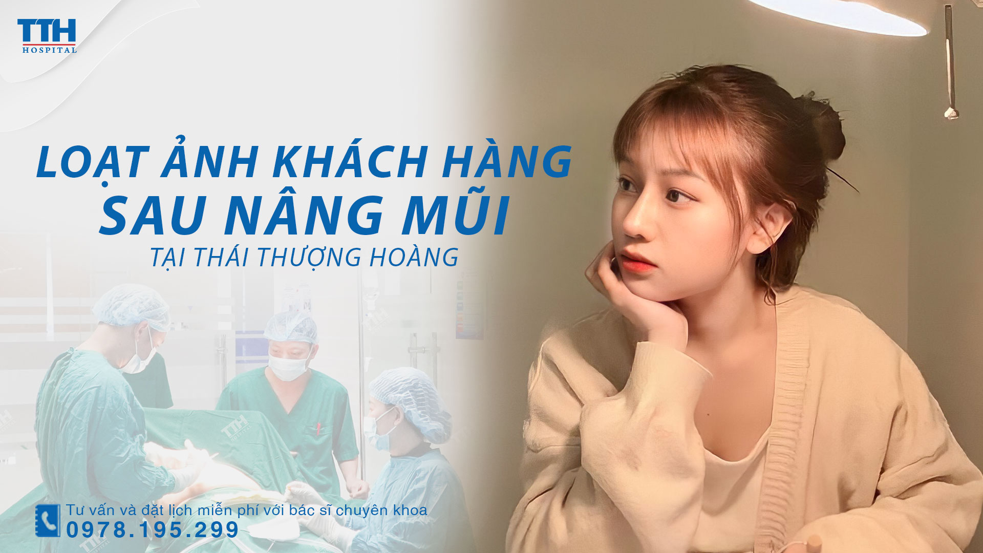 Loạt hình ảnh khách hàng sau nâng mũi tại Bệnh viện Thái Thượng Hoàng - Địa chỉ thẩm mỹ uy tín Nghệ An, Hà Tĩnh