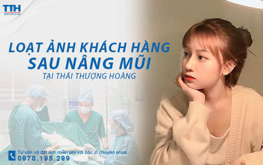 Loạt hình ảnh khách hàng sau nâng mũi tại Bệnh viện Thái Thượng Hoàng - Địa chỉ thẩm mỹ uy tín Nghệ An, Hà Tĩnh