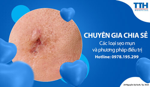 Các loại sẹo mụn và phương pháp điều trị