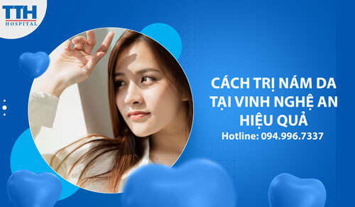 Cách Trị Nám da Tại Vinh Nghệ An Hiệu Quả