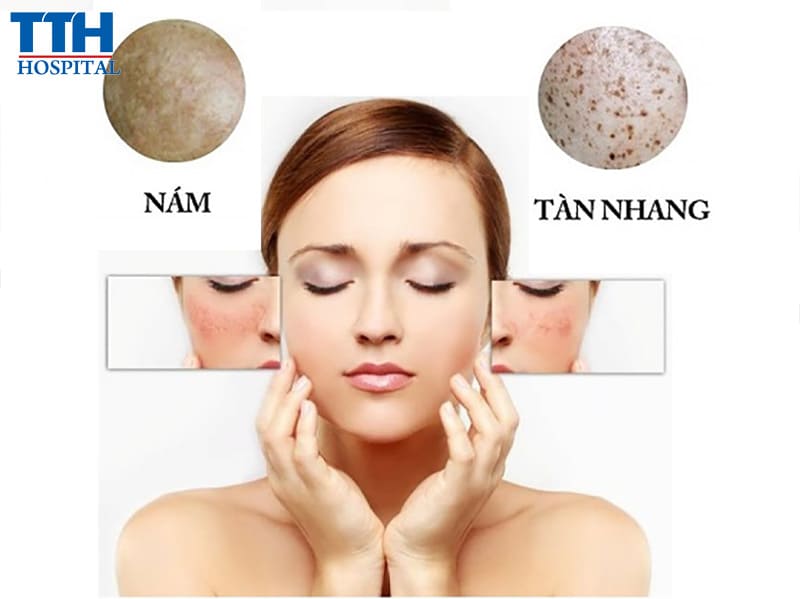 Cách trị nám, tàn nhang hiệu quả cho phái đẹp