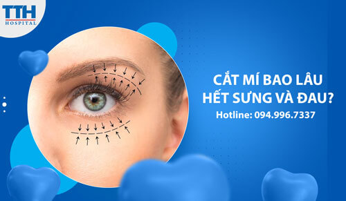 Cắt Mí Bao Lâu Hết Sưng và Đau?