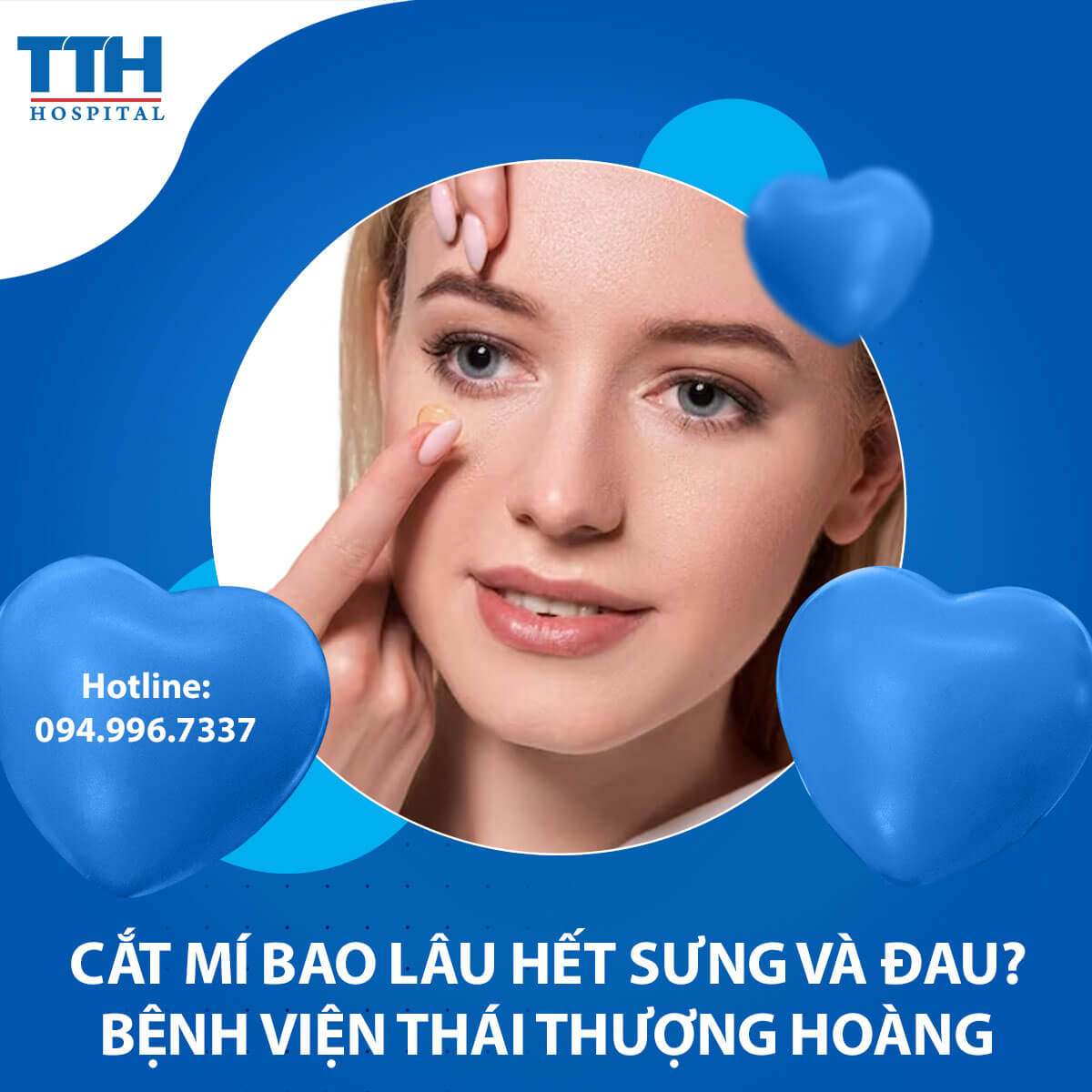 Cắt Mí Bao Lâu Hết Sưng và Đau?