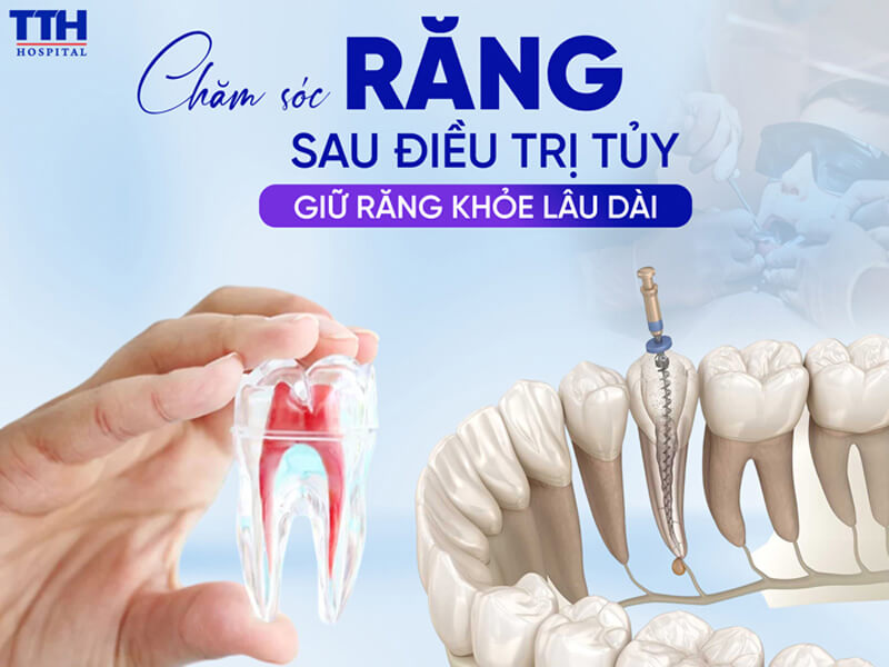 CHĂM SÓC RĂNG SAU ĐIỀU TRỊ TỦY – GIỮ RĂNG KHỎE LÂU DÀI