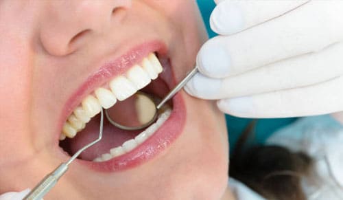 Chi Phí Bọc Răng Sứ Cho Việt Kiều Về Nước Dịp Tết