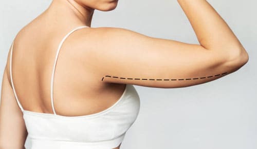 Có Nên Hút Mỡ Bắp Tay Không?