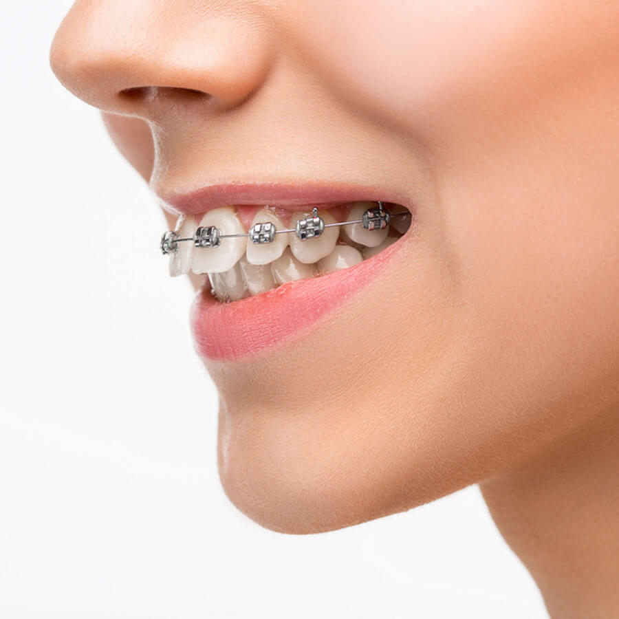 Có niềng răng 1 hàm được không? 