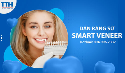Dán Răng Sứ Smart Veneer