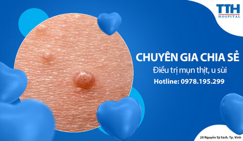 Điều trị mụn thịt, u sùi