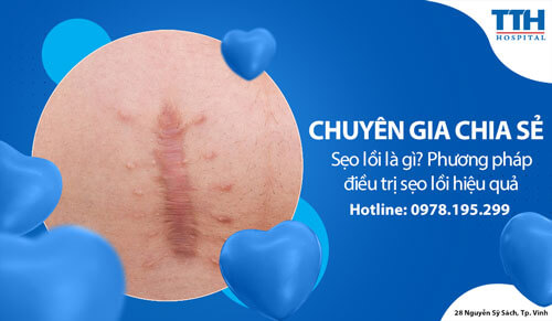 Điều trị sẹo lồi hiệu quả với công nghệ Laser CO2 Fractional