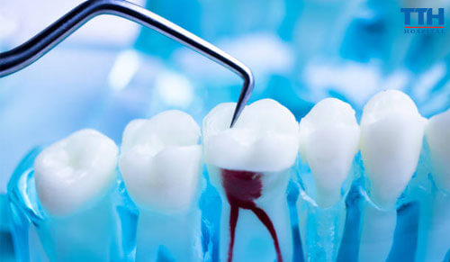 Điều Trị Tủy Có Đau Không?