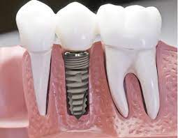 Trồng răng Implant