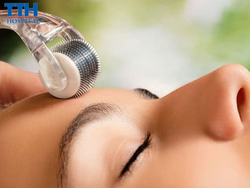 Hướng Dẫn Chăm Sóc Da Sau Điều Trị Sẹo Rỗ, Lăn Kim PRP