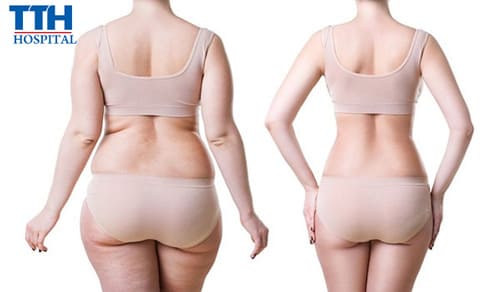 Hút mỡ toàn thân có an toàn không?