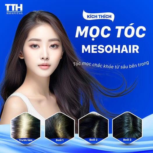 Kích Thích Mọc Tóc Bằng Mesotherapy