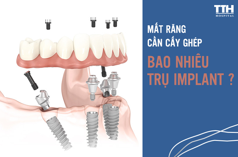 MẤT HẾT RĂNG THÌ CẦN PHẢI CẤY BAO NHIÊU IMPLANT ?